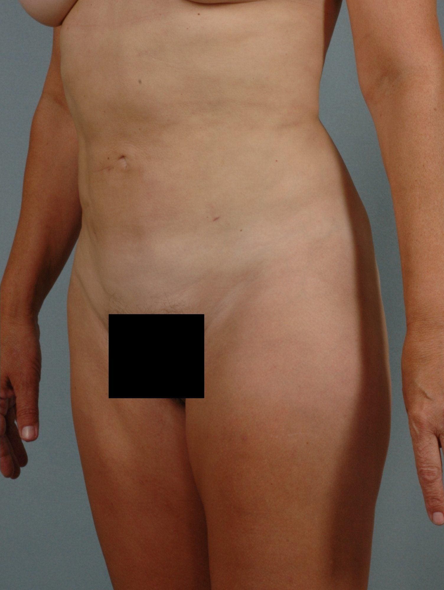 Liposuction Patient Photo - Case 16923 - after view-3
