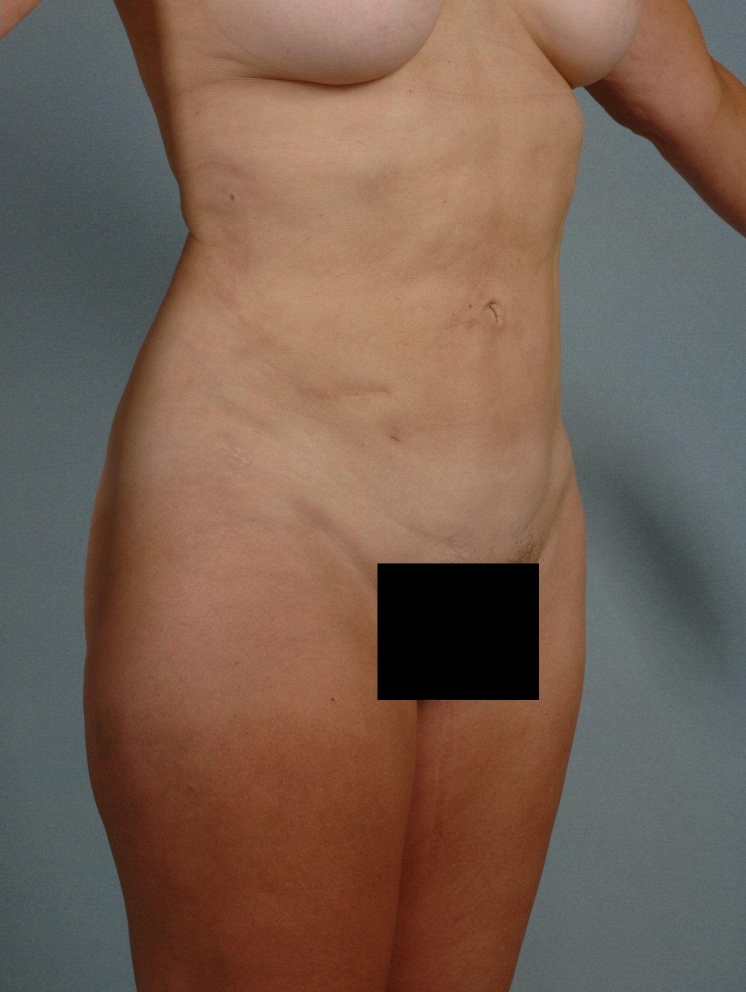 Liposuction Patient Photo - Case 16923 - after view-4