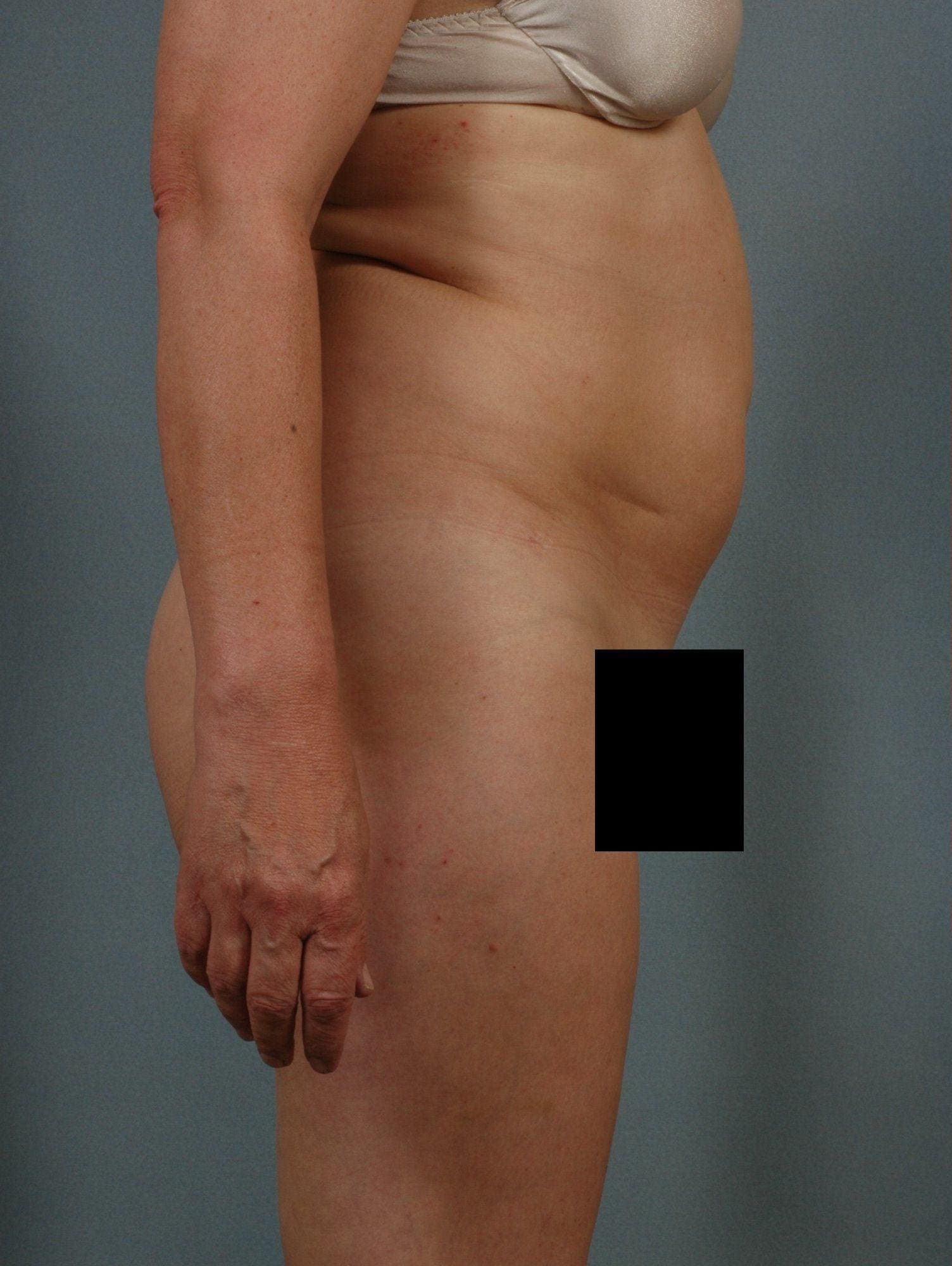 Liposuction Patient Photo - Case 16923 - before view-2