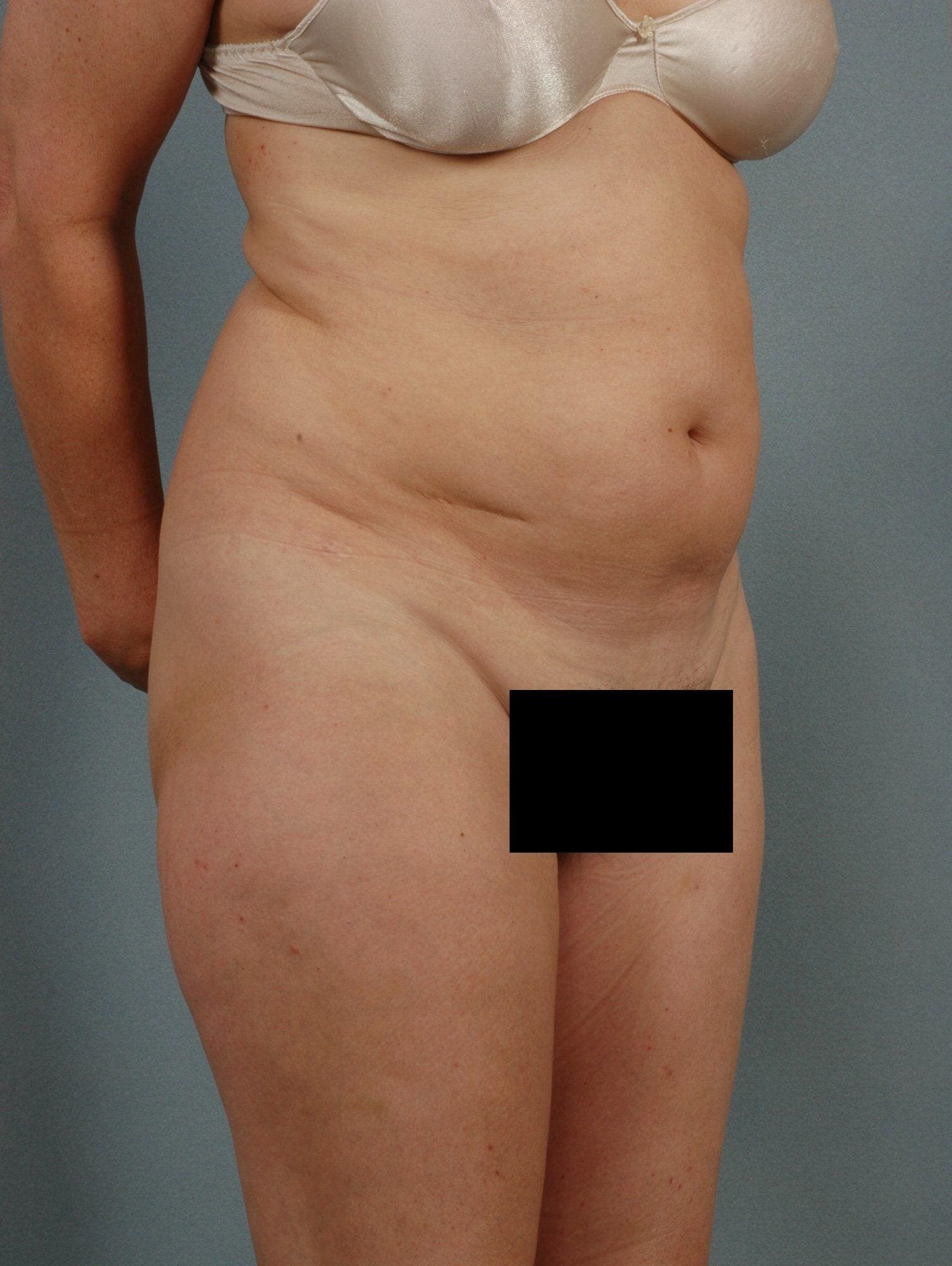 Liposuction Patient Photo - Case 16923 - before view-4