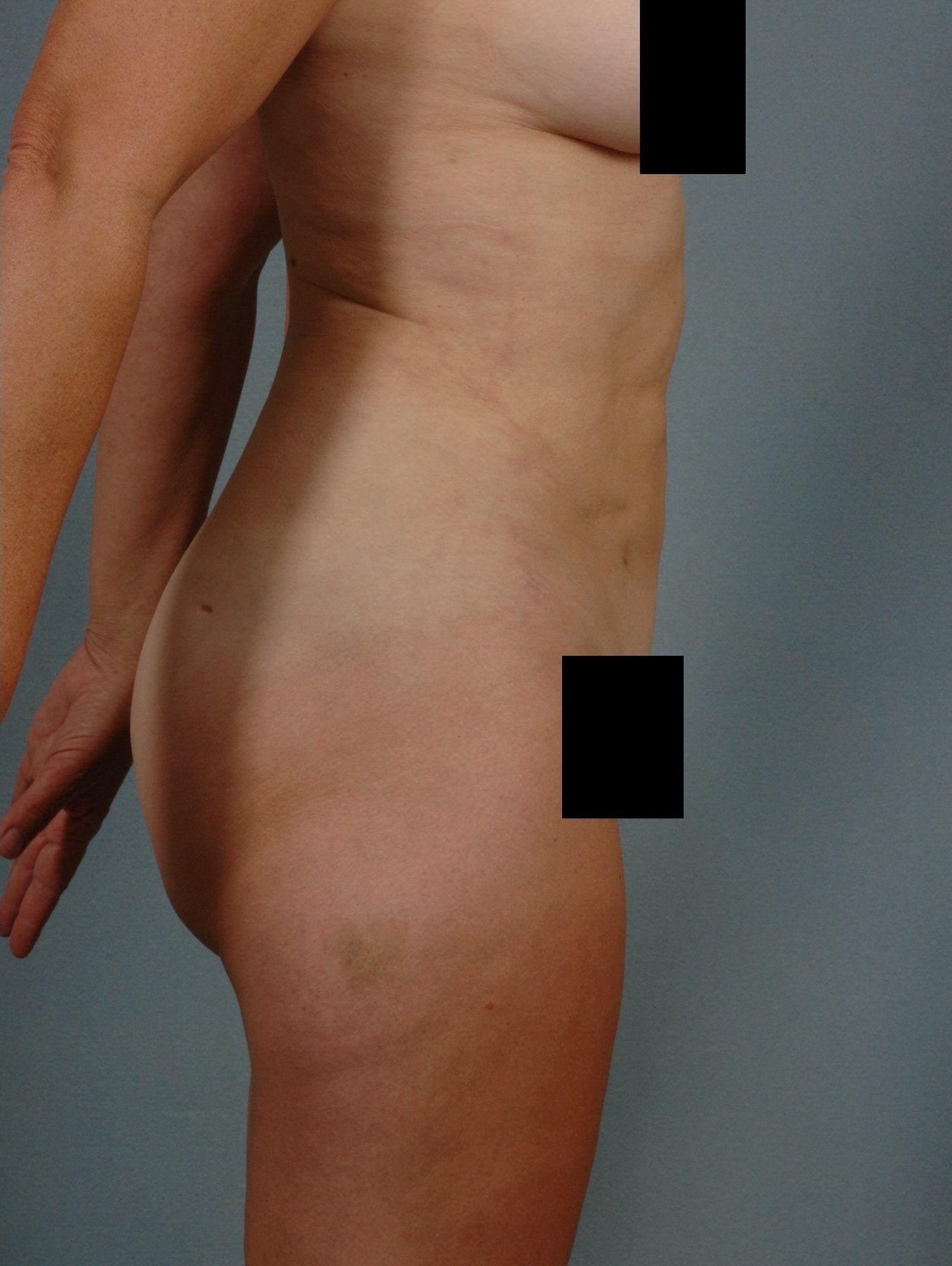Liposuction Patient Photo - Case 16923 - after view-2