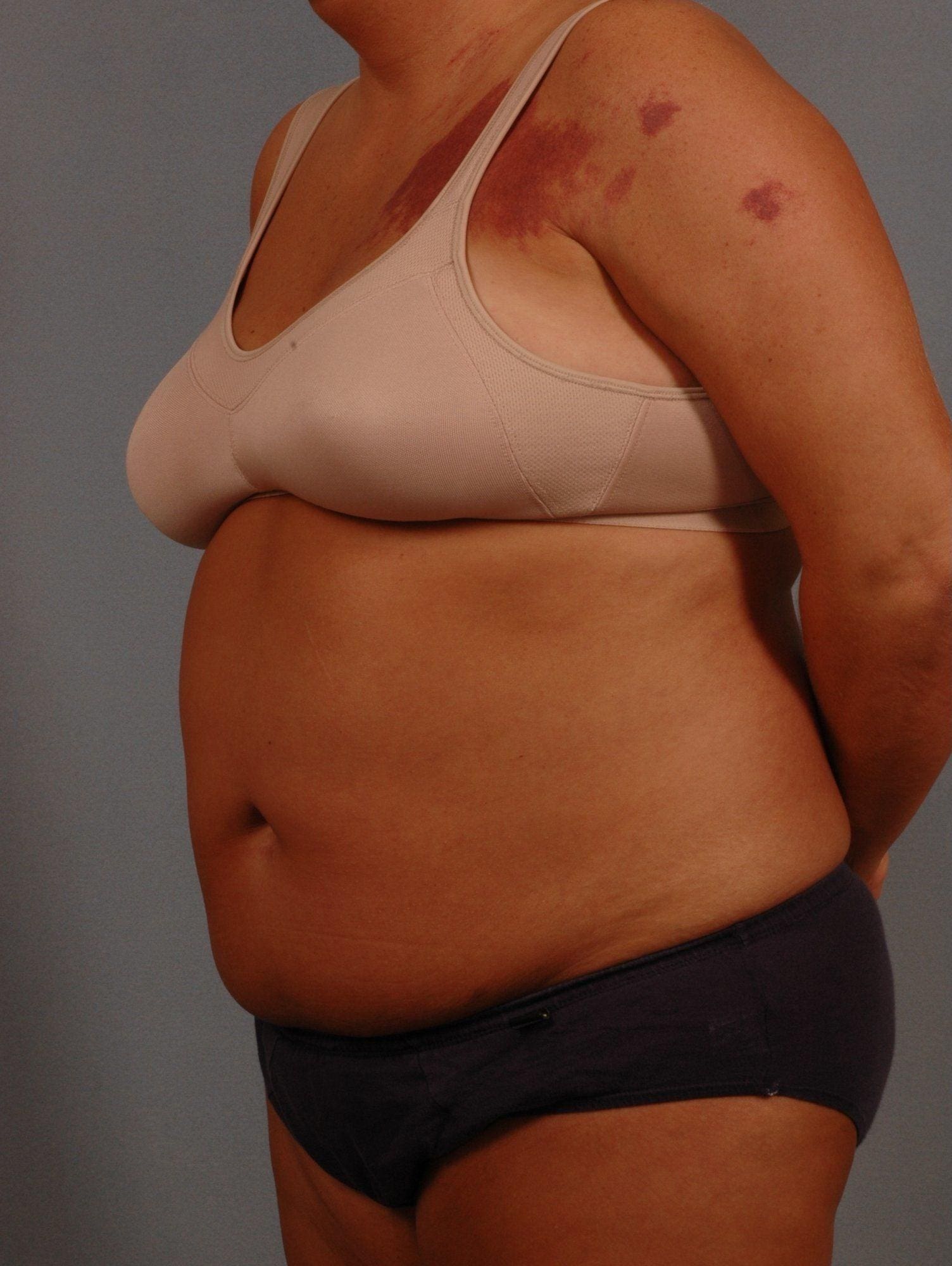 Liposuction Patient Photo - Case 16937 - before view-3