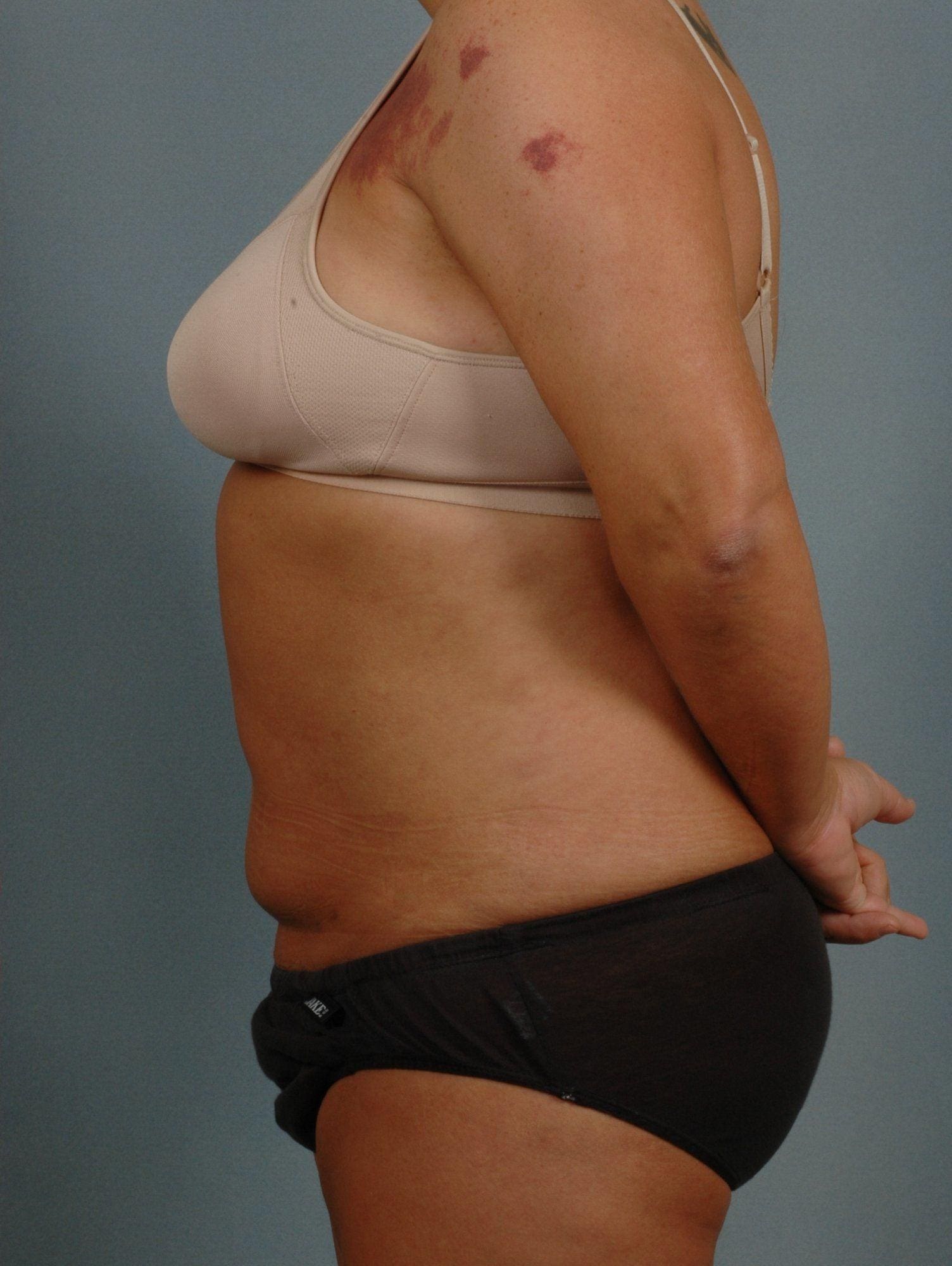 Liposuction Patient Photo - Case 16937 - after view-1