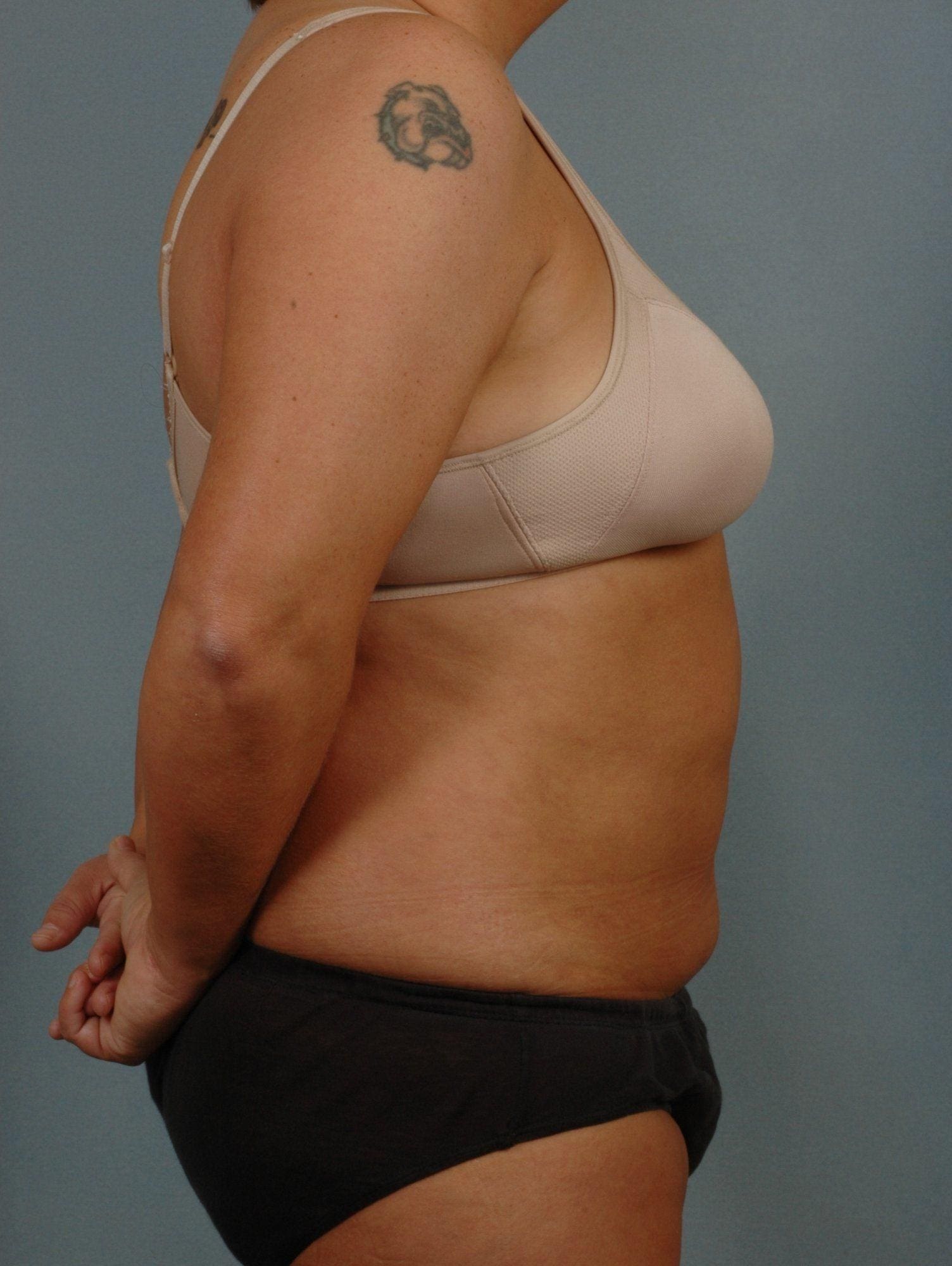 Liposuction Patient Photo - Case 16937 - after view-2