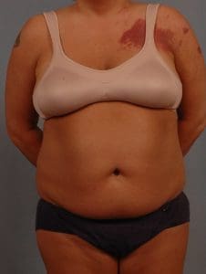 Liposuction - Case 16937 - Before