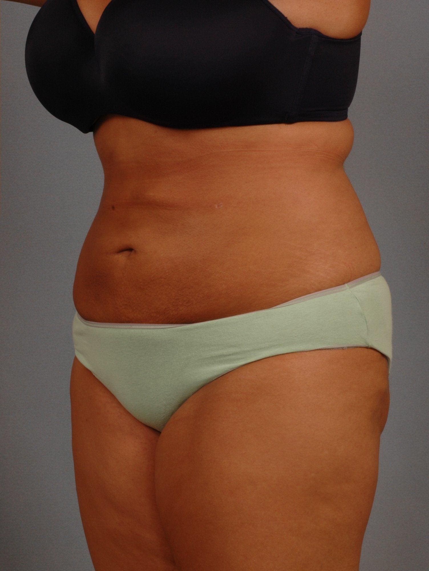 Liposuction Patient Photo - Case 16949 - after view-3
