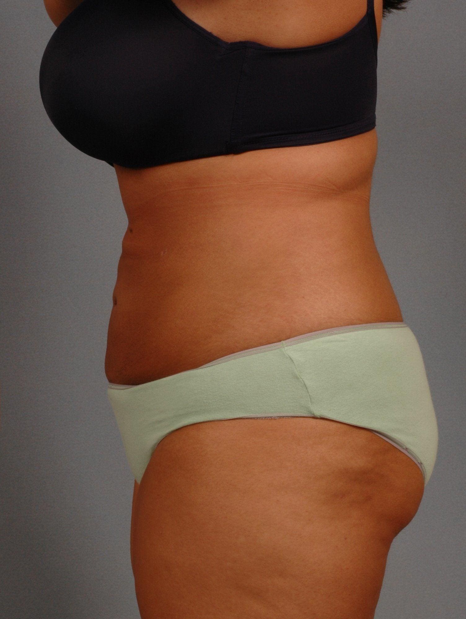 Liposuction Patient Photo - Case 16949 - after view-1