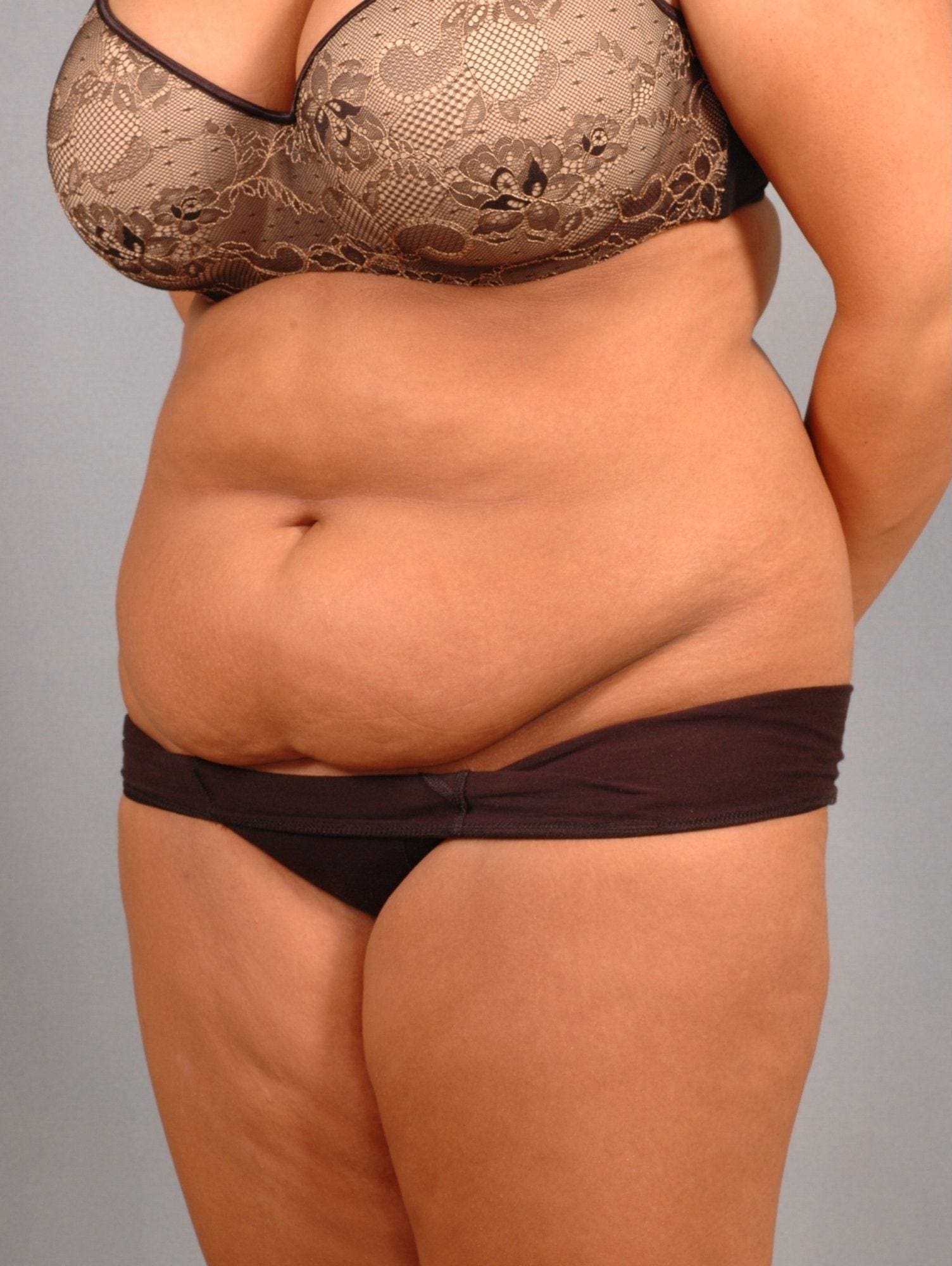 Liposuction Patient Photo - Case 16949 - before view-3