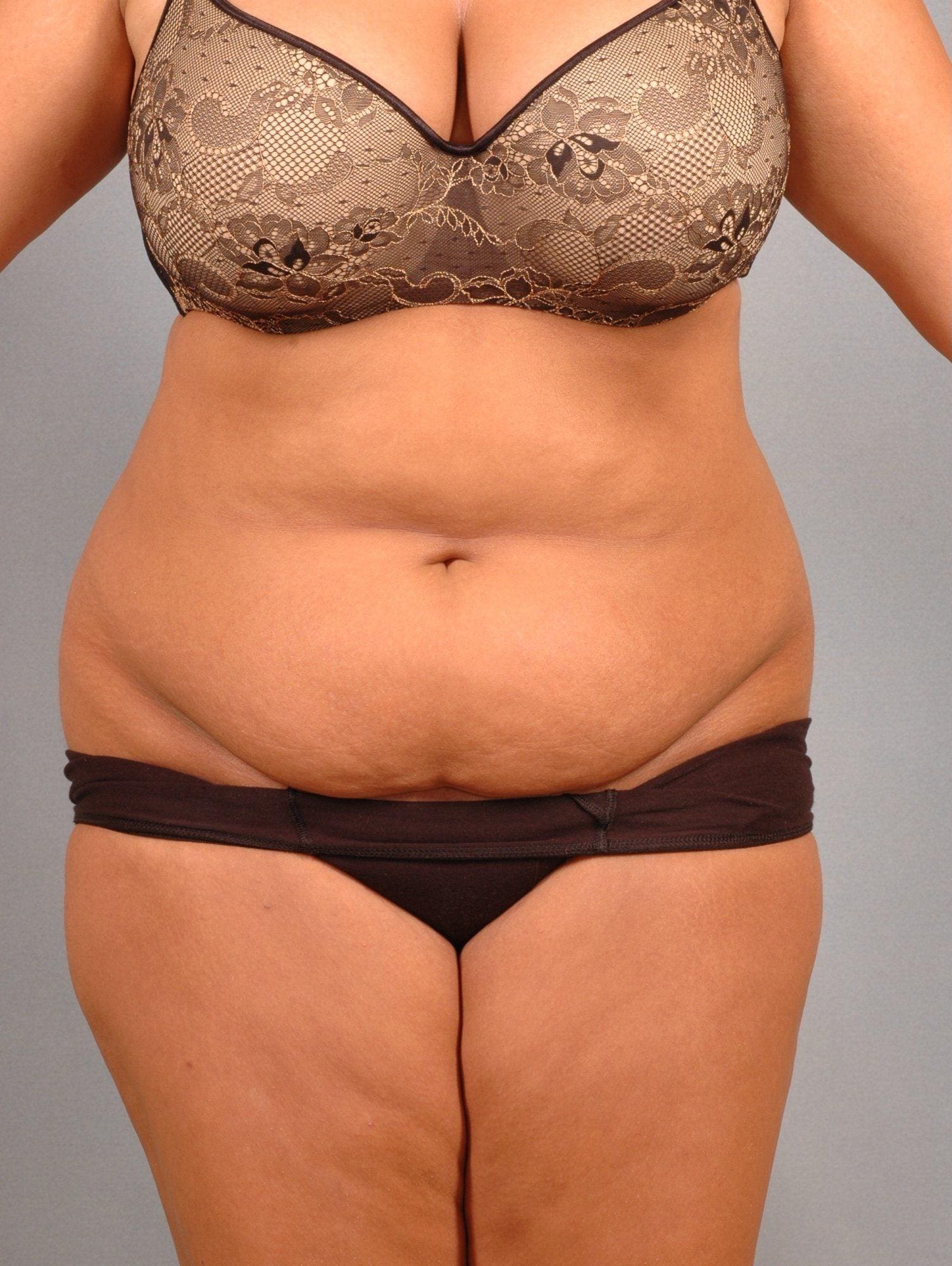 Liposuction Patient Photo - Case 16949 - before view-