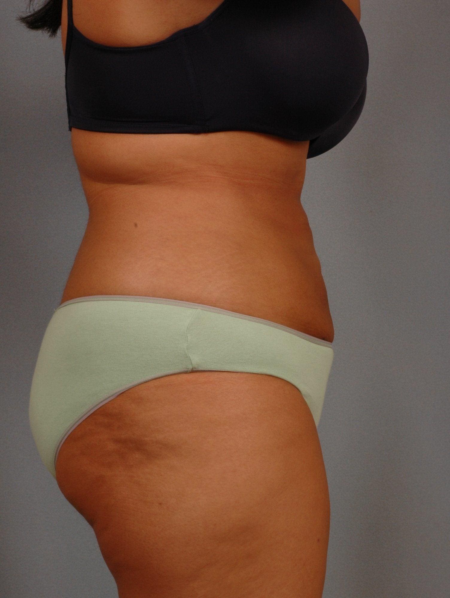 Liposuction Patient Photo - Case 16949 - after view-2