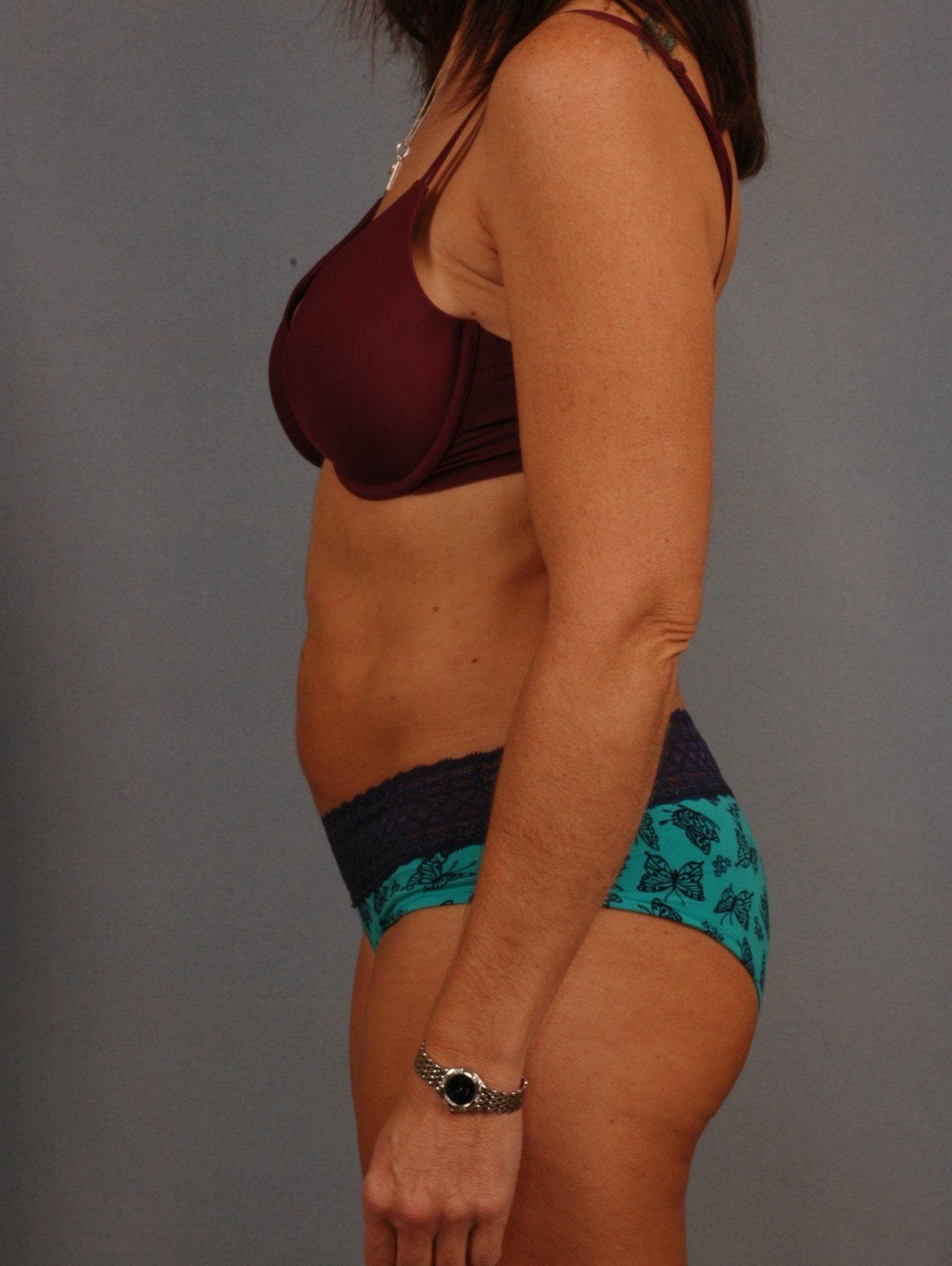 Liposuction Patient Photo - Case 16961 - after view-1