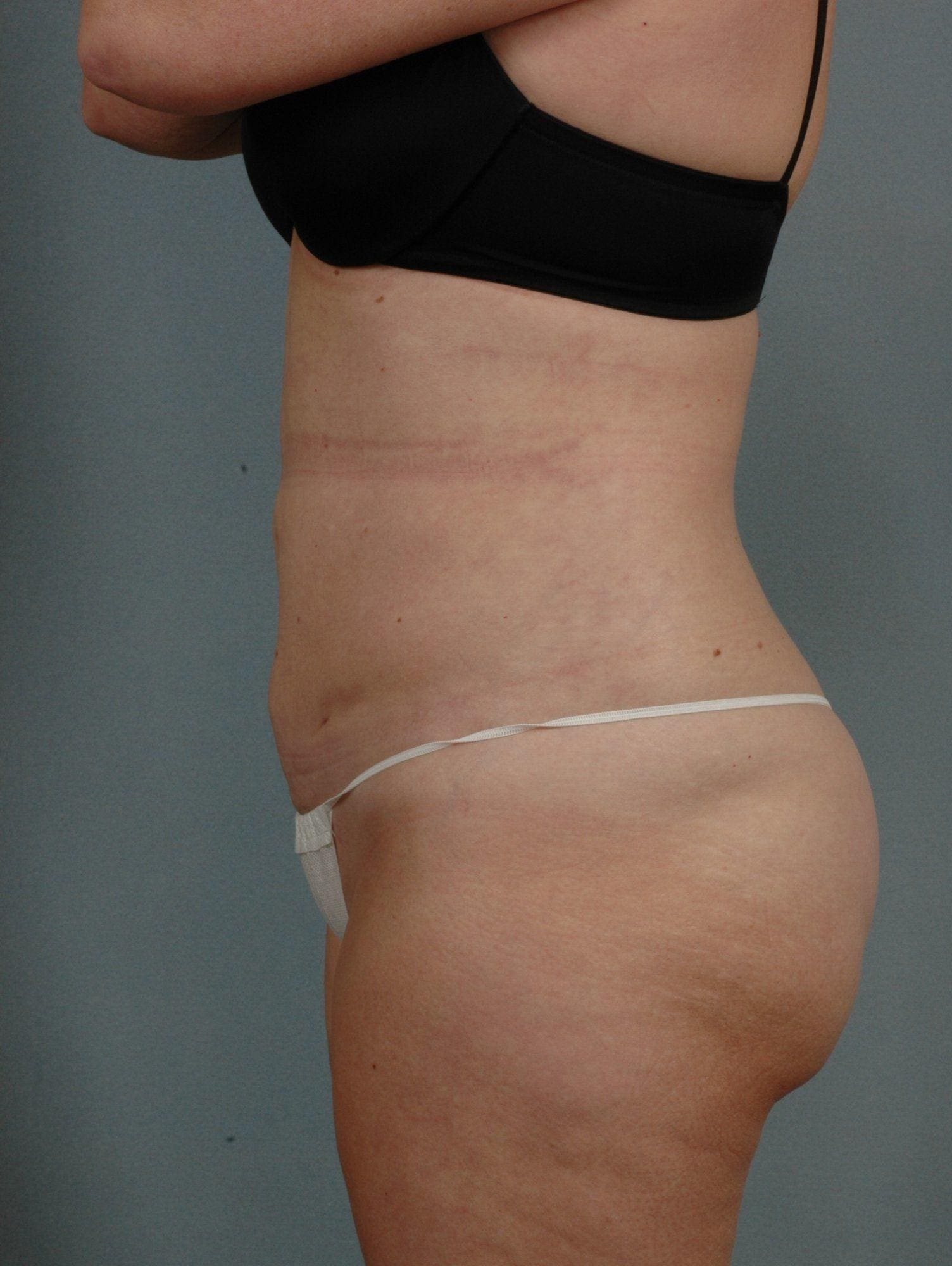 Liposuction Patient Photo - Case 16974 - after view-1