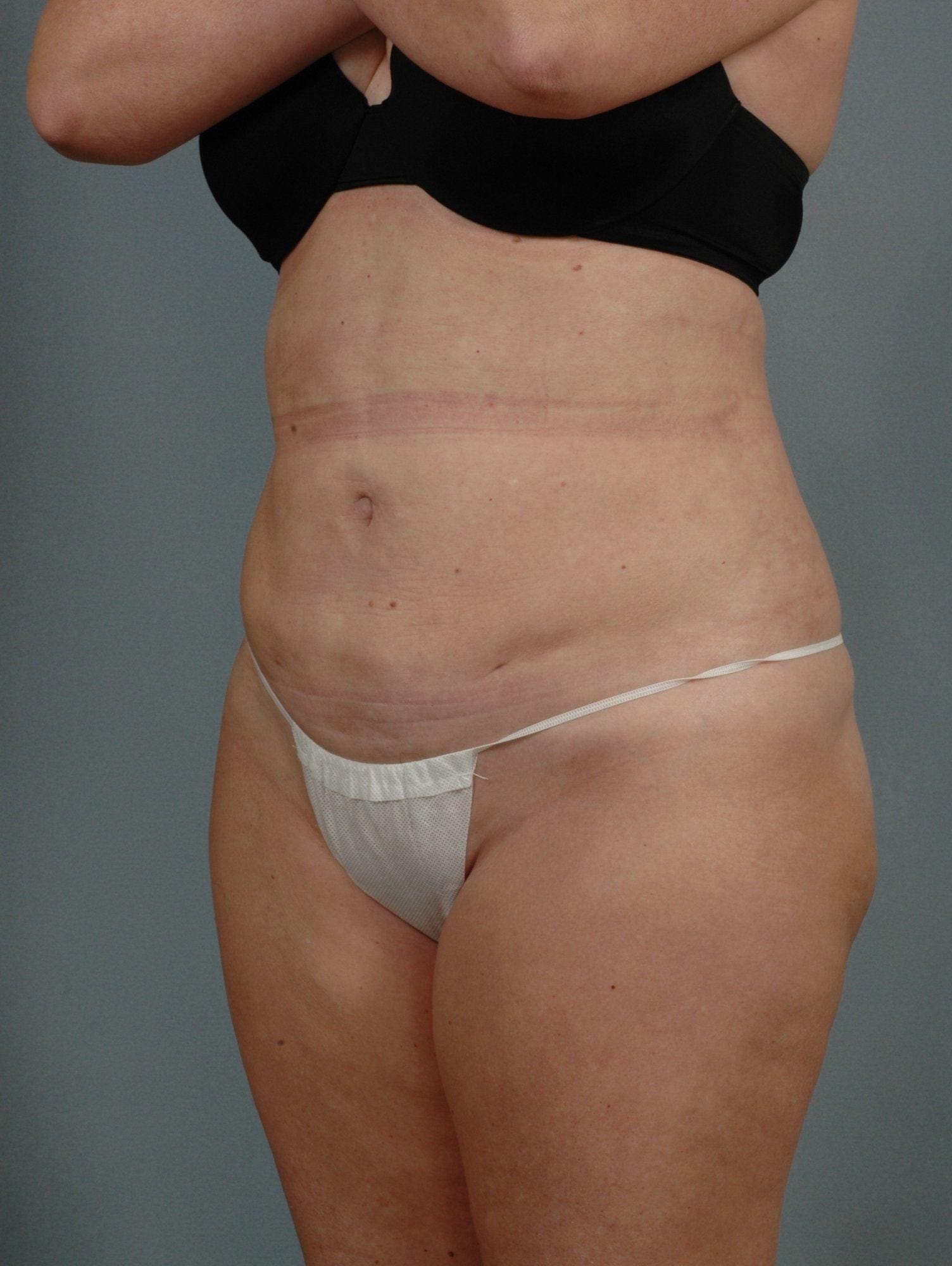 Liposuction Patient Photo - Case 16974 - after view-2