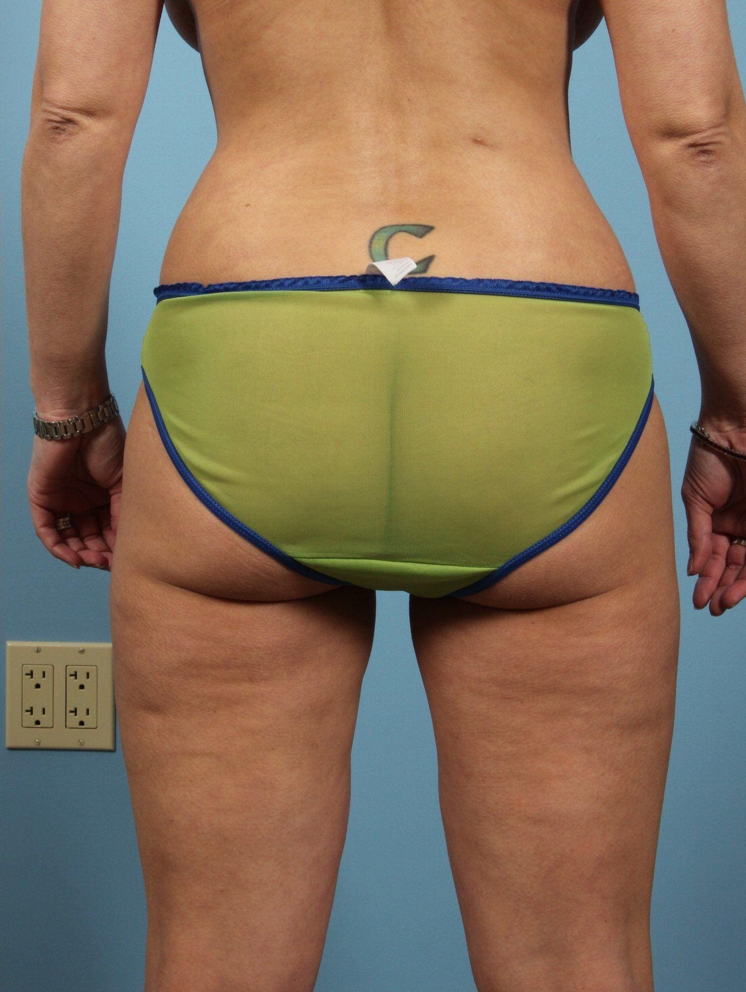 Liposuction Patient Photo - Case 16982 - after view-1