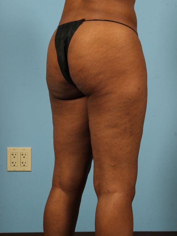 Liposuction Patient Photo - Case 17019 - before view-5