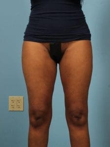 Liposuction - Case 17019 - After