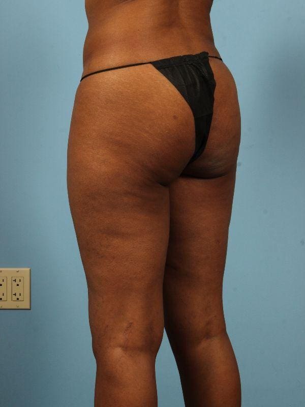 Liposuction Patient Photo - Case 17019 - before view-4