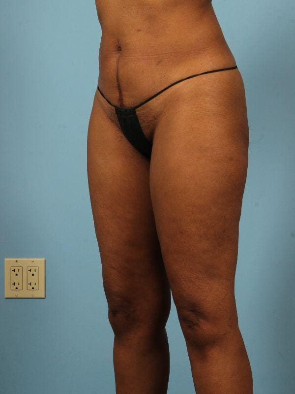 Liposuction Patient Photo - Case 17019 - before view-3