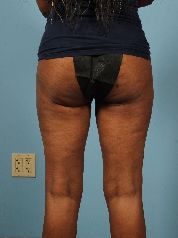 Liposuction Patient Photo - Case 17019 - after view-1