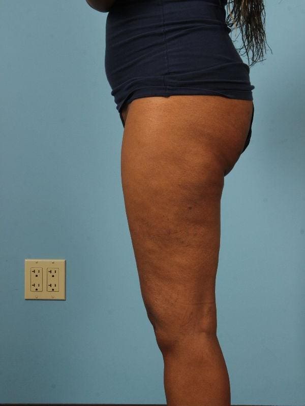Liposuction Patient Photo - Case 17019 - after view-2
