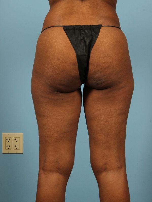 Liposuction Patient Photo - Case 17019 - before view-1