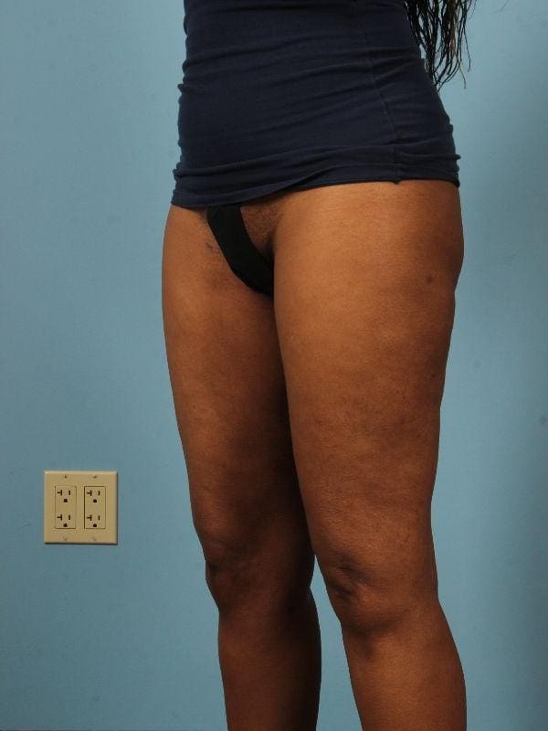 Liposuction Patient Photo - Case 17019 - after view-3