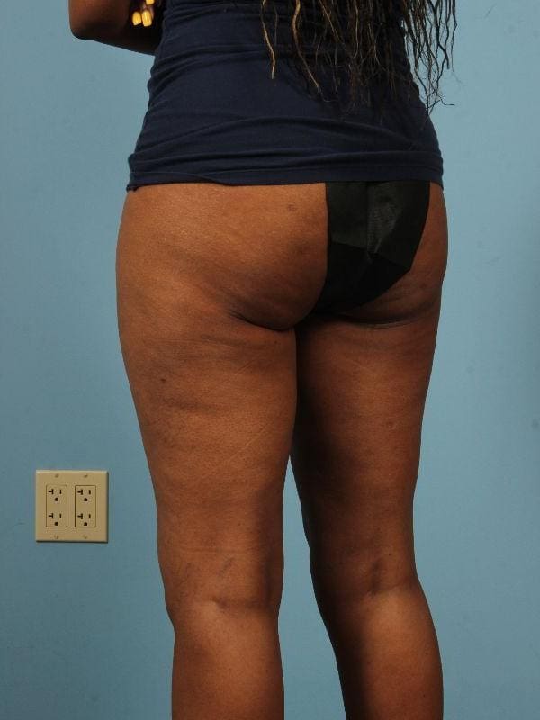 Liposuction Patient Photo - Case 17019 - after view-4