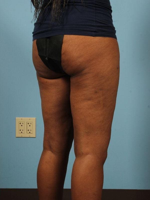Liposuction Patient Photo - Case 17019 - after view-5