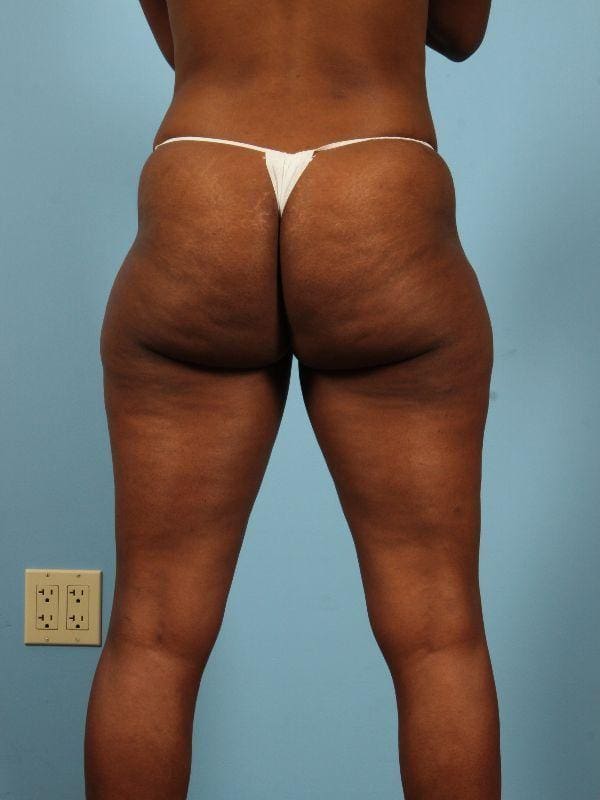 Liposuction Patient Photo - Case 17033 - before view-1