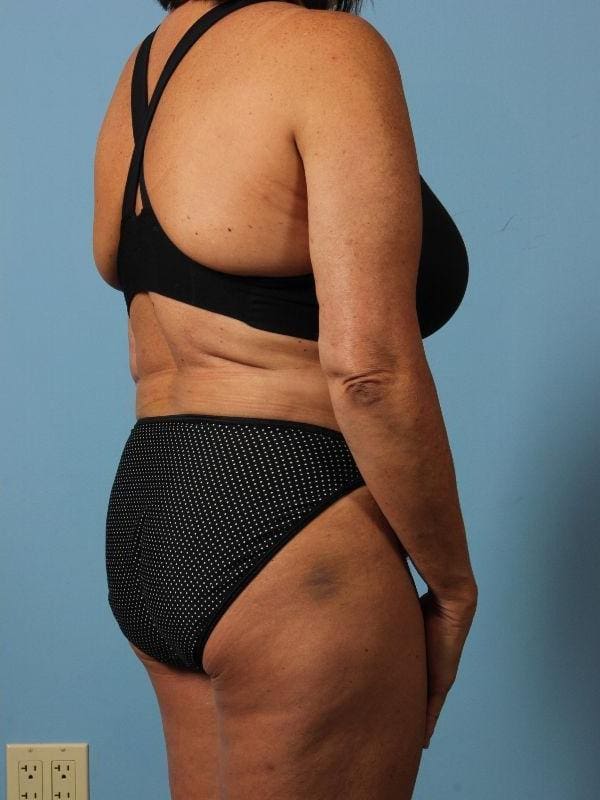 Liposuction Patient Photo - Case 17052 - after view-4