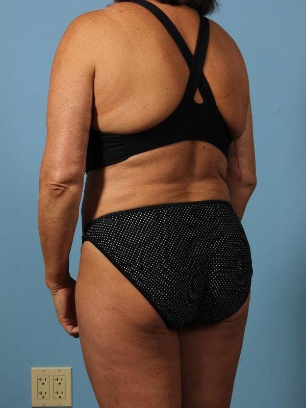 Liposuction Patient Photo - Case 17052 - after view-3