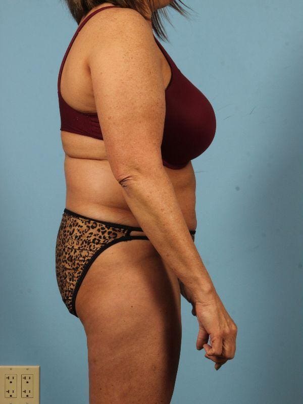 Liposuction Patient Photo - Case 17052 - before view-2