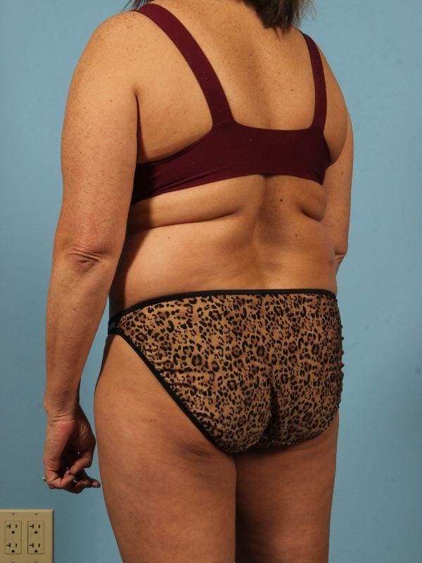 Liposuction Patient Photo - Case 17052 - before view-3