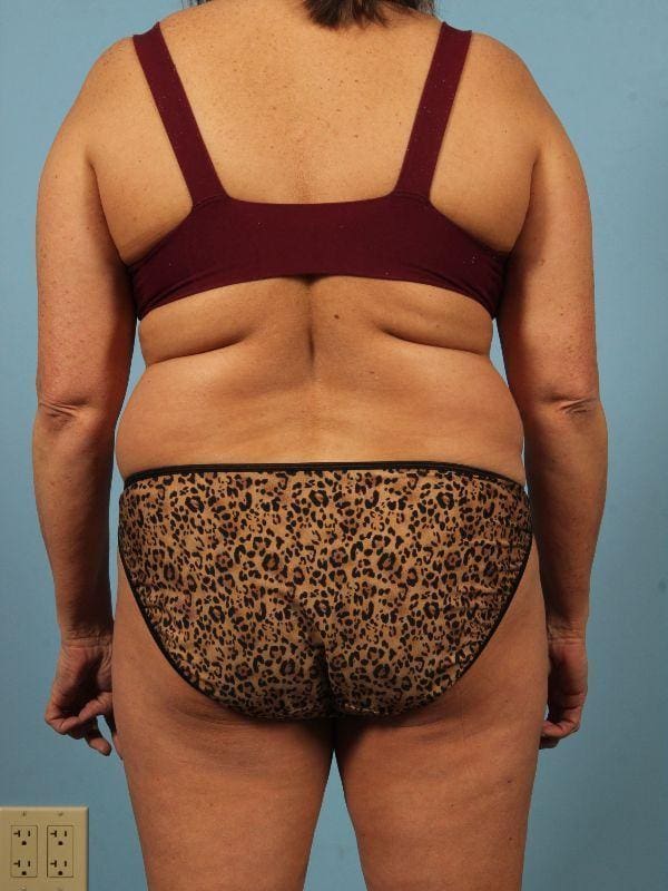 Liposuction Patient Photo - Case 17052 - before view-