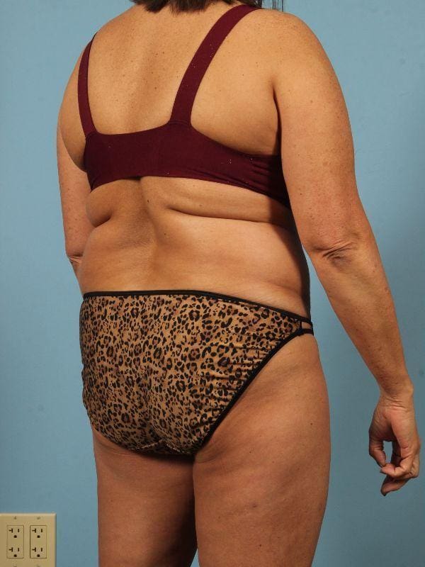 Liposuction Patient Photo - Case 17052 - before view-4