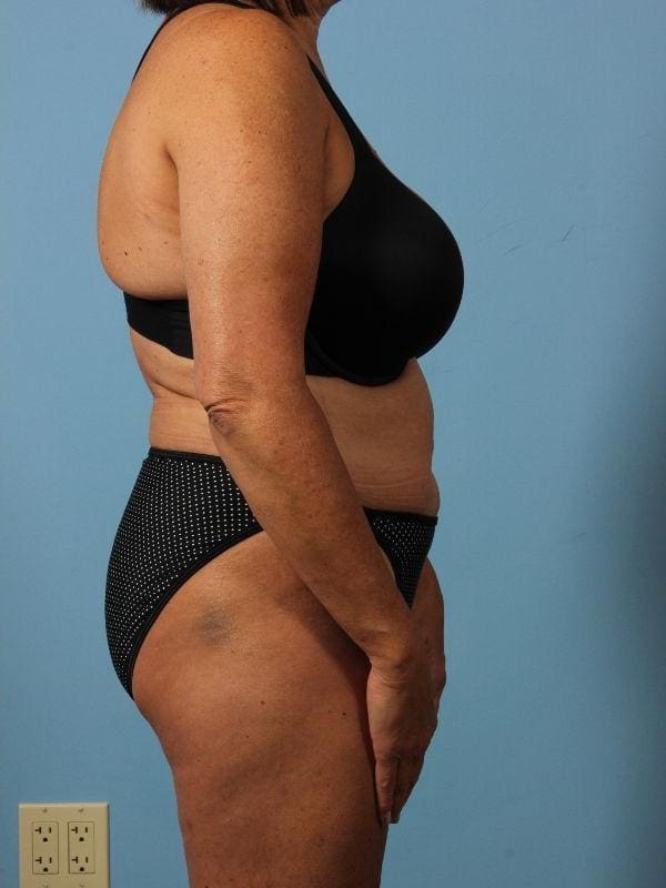 Liposuction Patient Photo - Case 17052 - after view-2