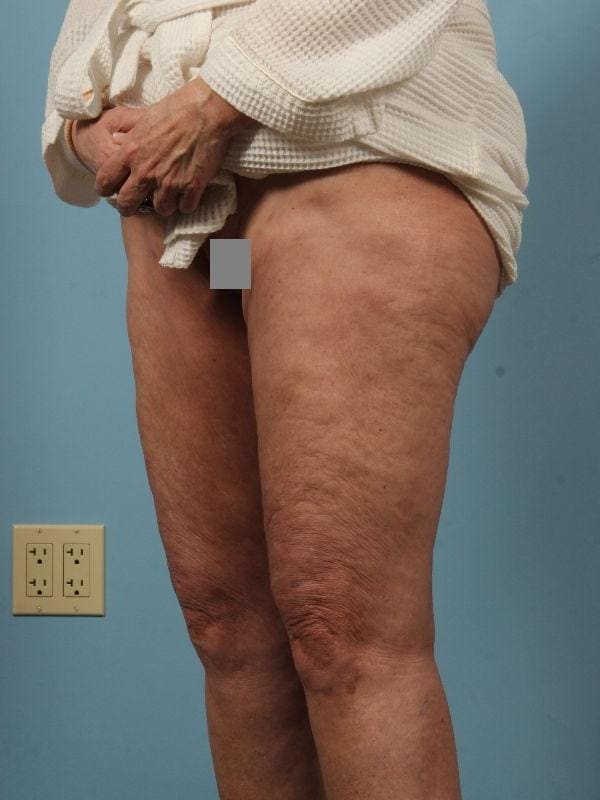 Liposuction Patient Photo - Case 17064 - after view-2