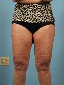 Liposuction - Case 17064 - Before