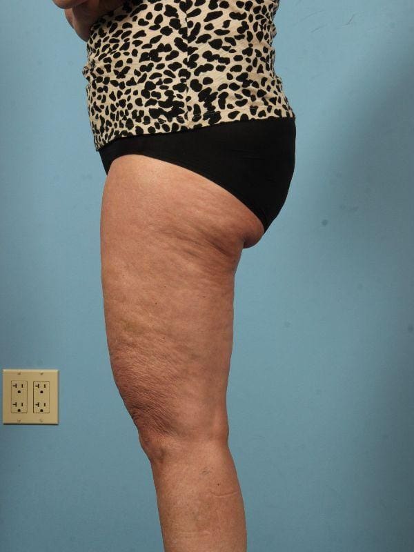 Liposuction Patient Photo - Case 17064 - before view-1