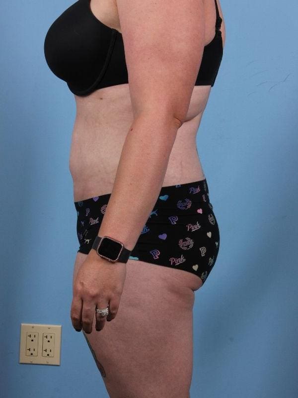 Liposuction Patient Photo - Case 17087 - after view-1