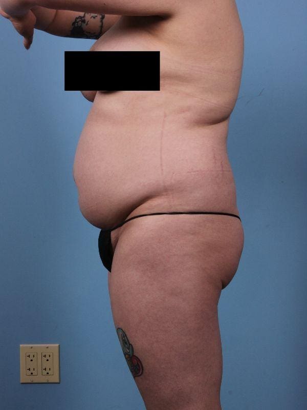 Liposuction Patient Photo - Case 17087 - before view-1