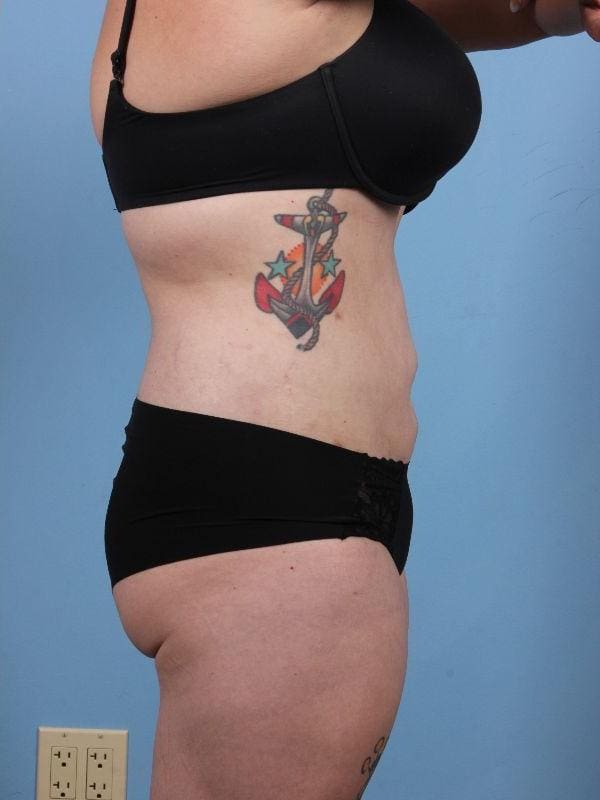 Liposuction Patient Photo - Case 17087 - after view-2