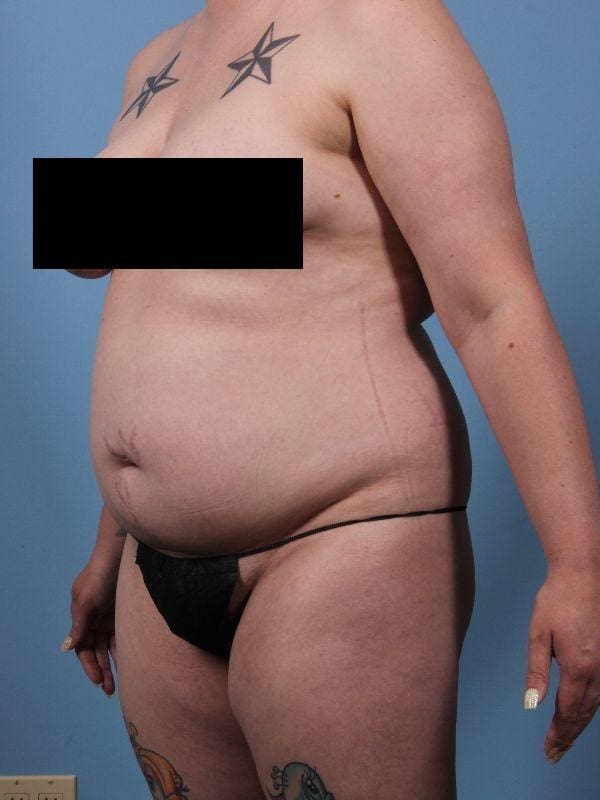 Liposuction Patient Photo - Case 17087 - before view-3