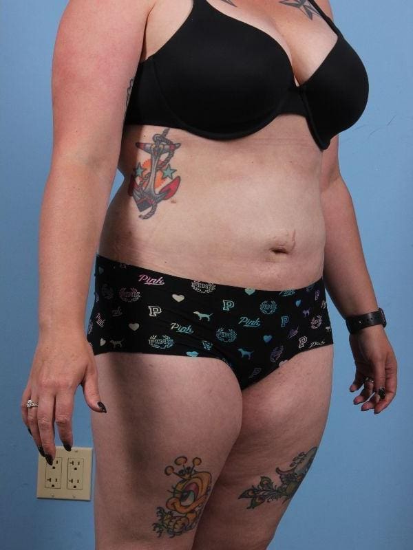 Liposuction Patient Photo - Case 17087 - after view-4