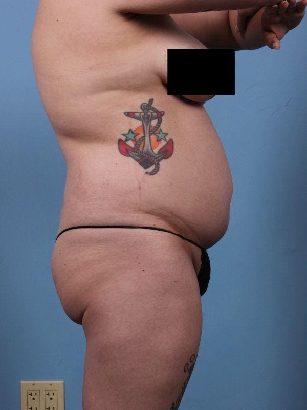 Liposuction Patient Photo - Case 17087 - before view-2