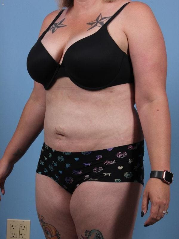 Liposuction Patient Photo - Case 17087 - after view-3