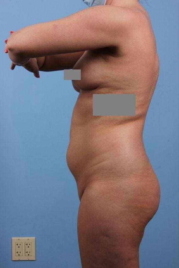 Liposuction Patient Photo - Case 17099 - before view-1