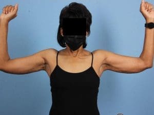 Liposuction - Case 17123 - After