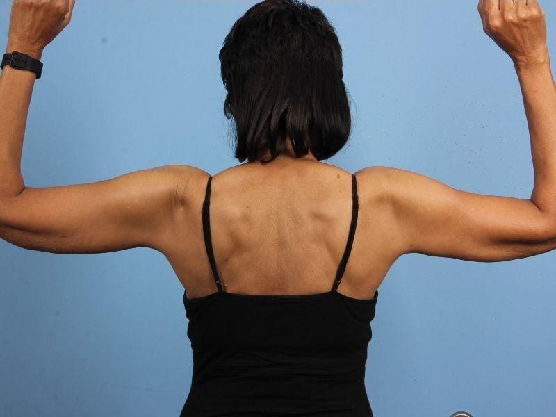 Liposuction Patient Photo - Case 17123 - after view-1
