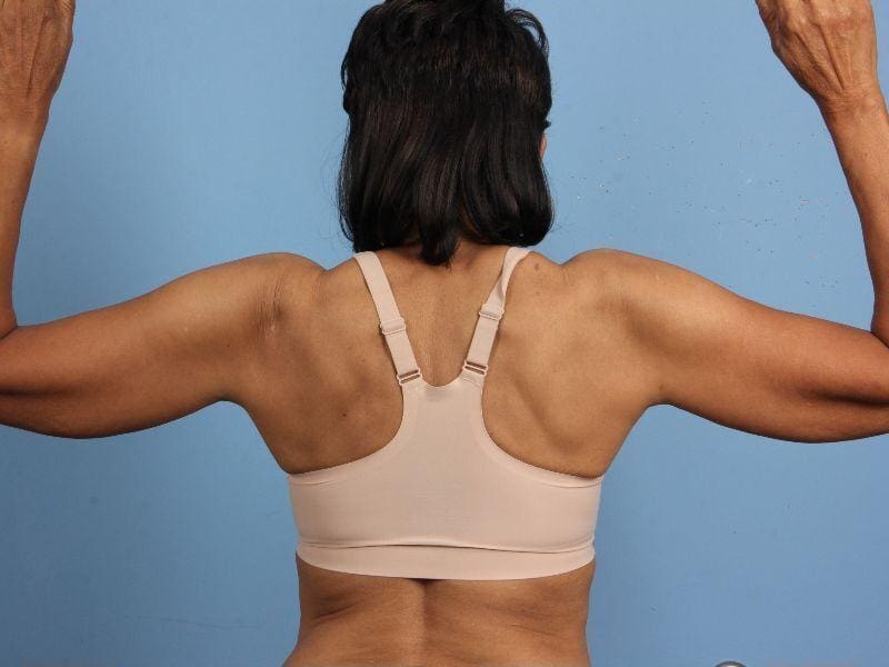 Liposuction Patient Photo - Case 17123 - before view-1
